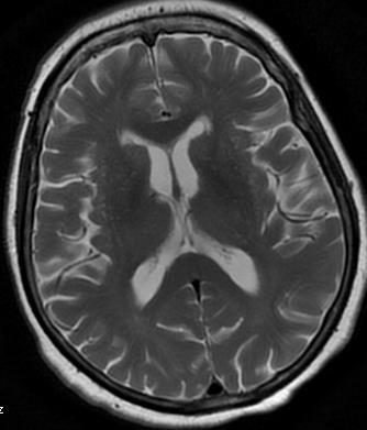 odkładanie Fe w hemochromatozie