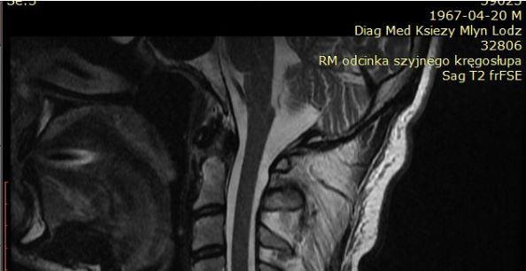 MRI strefy CCJ w procesie RZS ziarnina zapalna wokół zęba C2, ubytek w części górnej zęba (zaostrzenie szczytu C2) z.