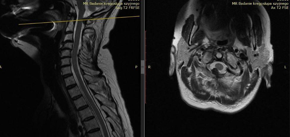 MRI z przekrojem na poziomie C1 zmiana nowotworowa łuku tylnego zawężająca światło kanału kręgowego (osteoid osteoma) Uwaga na nowotwory górnego rdzenia niedowłady