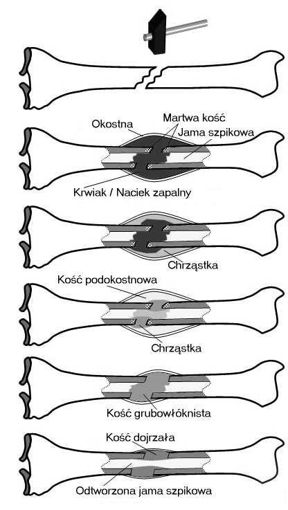 złamania Uraz Faza reaktywna - powstanienie krwiaka,