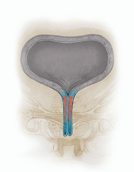 Urge Leakage occurs with a strong, sudden, and uncontrollable urge to urinate as a result of involuntary bladder contractions 1 Urge Urinary Incontinence 22% Mixed Urinary Incontinence 29% Stress