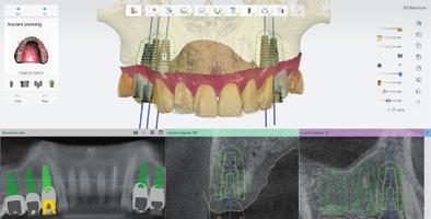 Większa liczba zlecanych prac dzięki przewodnikom chirurgicznym w ofercie Oprogramowanie 3Shape Implant Studio ułatwia