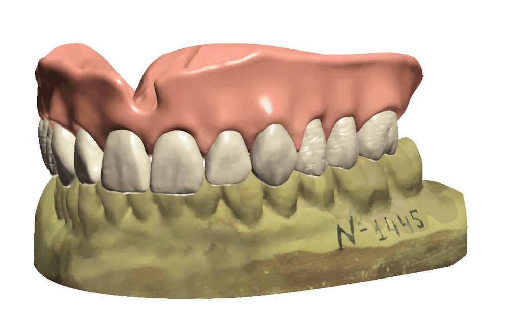 Cyfrowe przygotowanie protez całkowitych Połączenie najnowszej wersji oprogramowania Denture Design firmy 3Shape oraz nowych możliwości w obszarze produkcji czyni tę usługę bardzo atrakcyjną dla