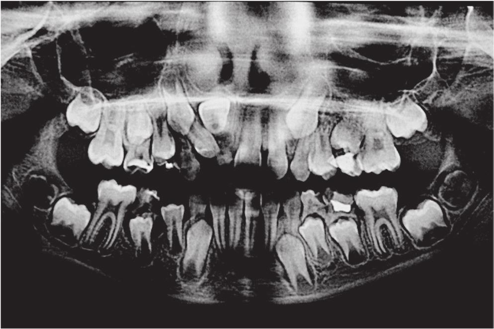 odontomas, healing of the alveolus after premature extraction of primary tooth, persistent primary teeth, also infections and consequences of traumas, to play a role in such condition [1, 2]