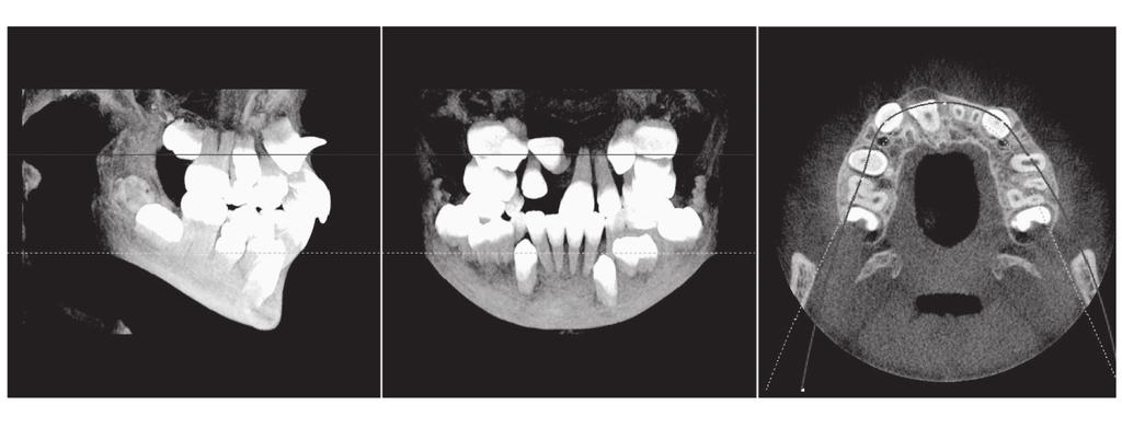 Atypical dislocation of impacted permanent teeth in children 385 Fig. 5. The CT scan showing deep posi on of tooth 11. Ryc. 5. Na zdjęciu CT głęboko położony ząb 11. Fig. 6.