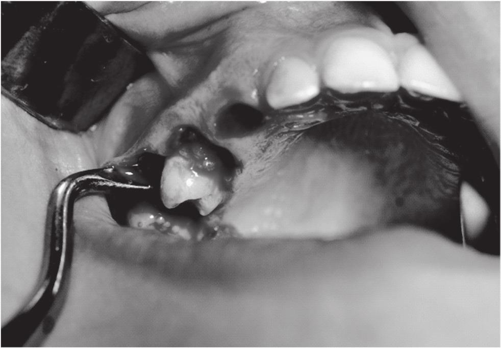 Changing the posi on of tooth 15 from horizontal to ver cal with the use of a