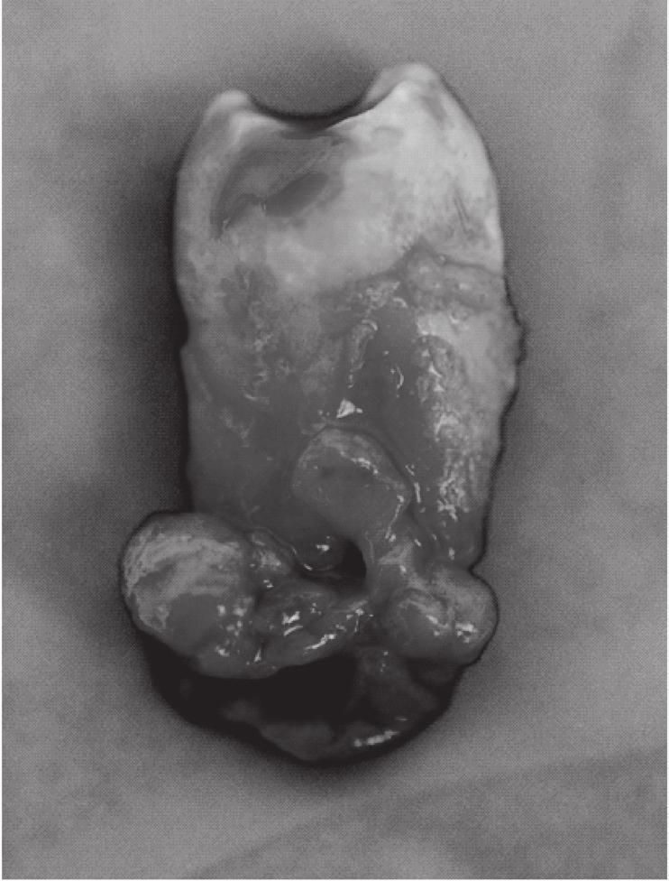 Atypical dislocation of impacted permanent teeth in children 387 Table I. Numerical colla on of translocated, impacted secondary teeth in children. Tabela I.