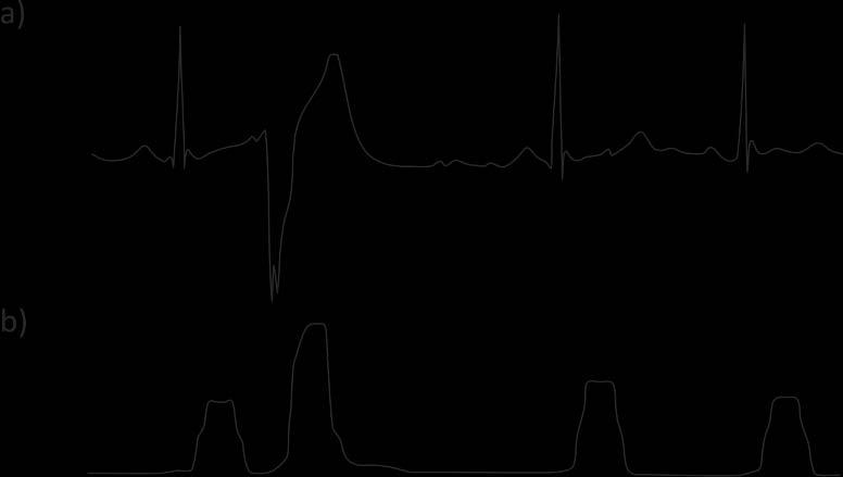 sygnał EKG Filtracja liniowa Filtracja nieliniowa funkcja detekcyjna Wyznaczenie maksimów Decyzja punkty detekcji Moduł wstępnego przetwarzania Moduł decyzyjny Rysunek 3.