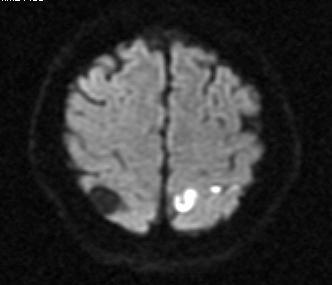 minutach udaru T2* GRE, SWI (obrazowanie podatności magnetycznej) obniżenie sygnału niedrożnej tętnicy DWI pozwala uwidocznić obszar
