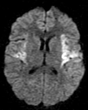 Diagnostyka różnicowa stroke mimickers W fazie nadostrej/ostrej