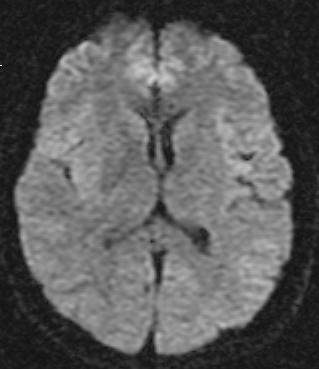 się rozpoznaniem błędnym Zapalenia Guzy (low grade glioma) Zawał