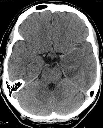 Stroke mimicker 50-letni mężczyzna,