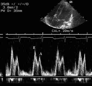 B. Mroziński i wsp., Czynność rozkurczowa prawej komory u niemowląt i małych dzieci z ASD II nej (MPAP, mean pulmonary artery pressure) wynosiło poniżej 30 mm Hg.
