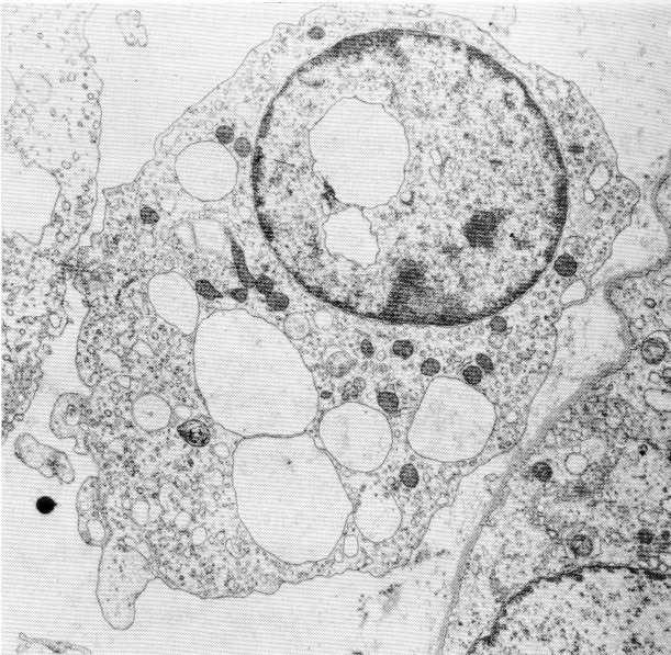 Hoffbauera (makrofagi) naczynia