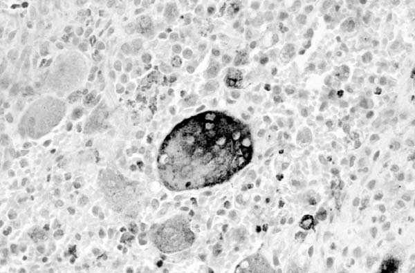 IV miesiąca) CT NK KD Komórki cytotrofoblastu wnikają do doczesnej, otaczają tętnice spiralne