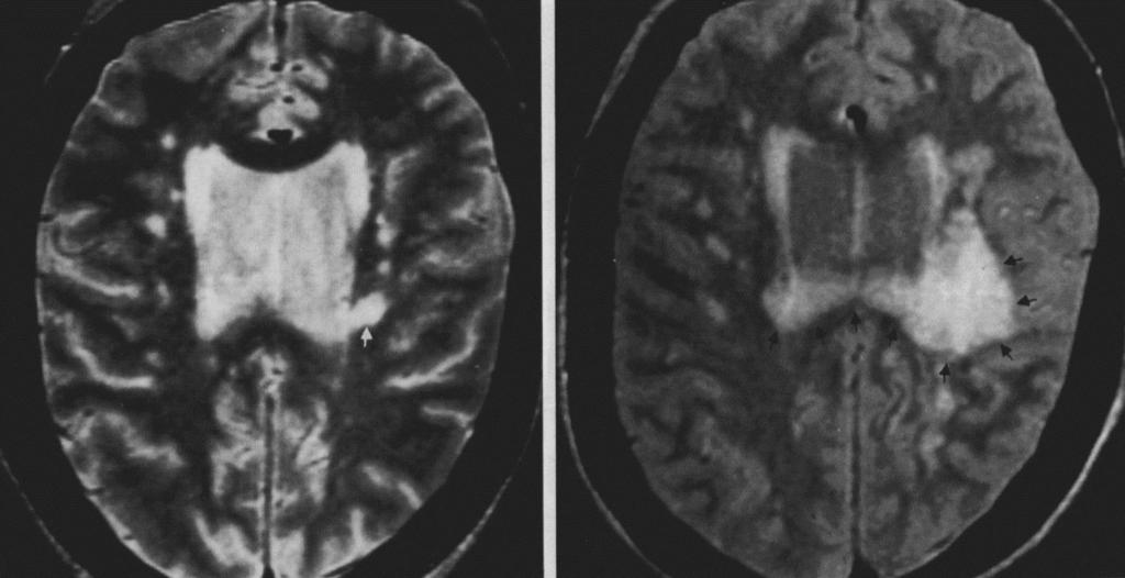 Progressive multifocal