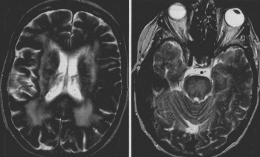 Diagnostyka różnicowa- zmiany niedokrwienne (leukoarajoza) vs