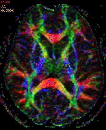 Obrazowanie tensora dyfuzji - DTI NIESPECYFICZNE obniżenie frakcjonowanej anizotropii (FA) i średniej dyfuzyjności