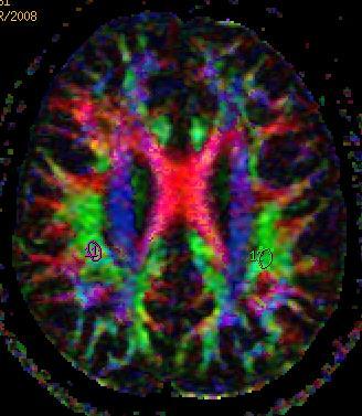 Commowick O et al.: Detection of DTI white matter abnormalities in multiple sclerosis patients.