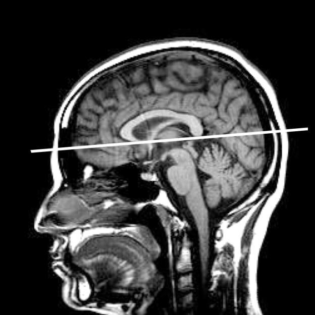 Zalecenia Polskiego Lekarskiego Towarzystwa Radiologicznego do stosowanego rutynowo protokołu badania MR u pacjentów ze stwardnieniem rozsianym Opracowanie: Marek Sąsiadek, Agata Majos, Katarzyna