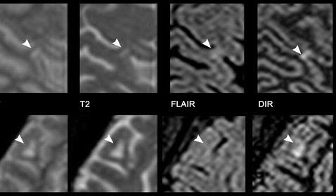 Double inversion recovery (DIR) ogniska podkorowe i korowe Geurts JJG et al.