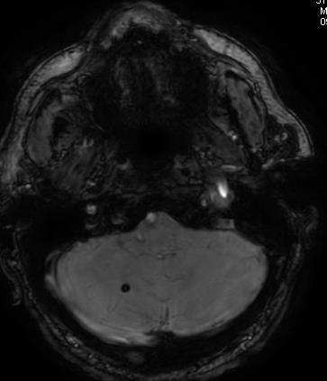 SWI (susceptibility weighted imaging) Sekwencja bardzo