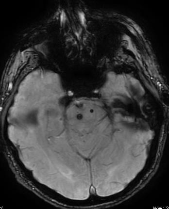 : Susceptibility-Weighted Imaging: Technical Aspects and