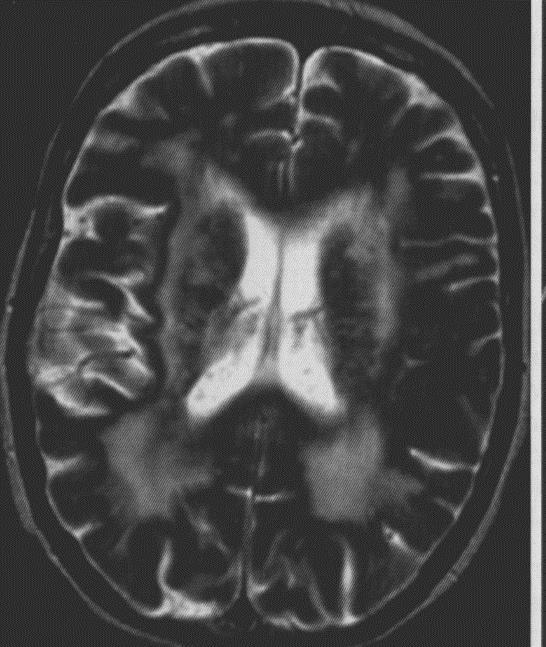 PODSUMOWANIE Badania obrazowe, zwłaszcza MR (pełen protokół), w łączności z obrazem klinicznym i innymi badaniami