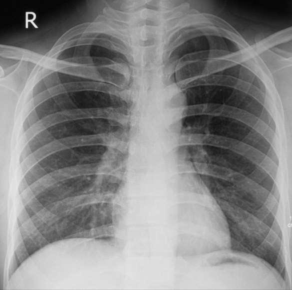 Anatomia radiologiczna klatki piersiowej Ao PPł LP PP KPS