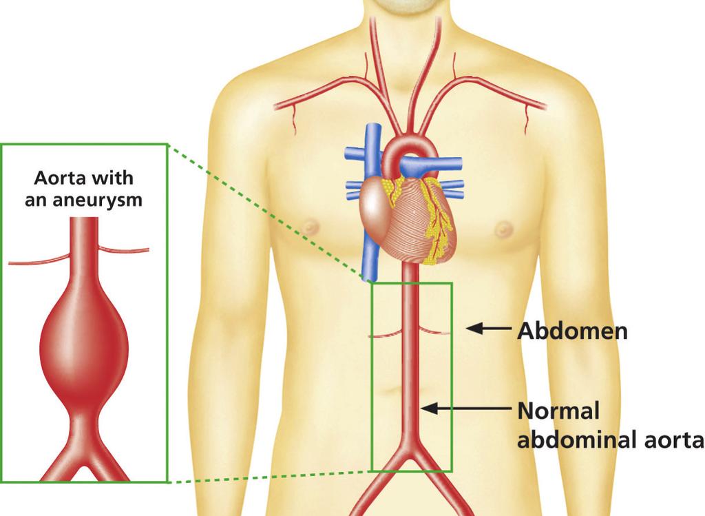 Wynik Twojego badania przesiewowego Zauważyliśmy, że część Twojej aorty jest o wiele szersza, niż powinna być. Oznacza to, że masz dużej wielkości tętniaka aorty brzusznej (ang.