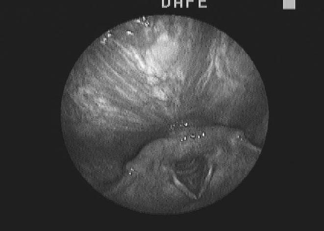 Autofl uorescencja tkankowa Ryc. 1. Obraz endoskopowy niezmienionej błony śluzowej w świetle białym i lampie ksenonowej Ryc. 2.