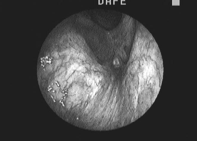 Ryc. 3. Obraz endoskopowy ogniska dysplazji w bliźnie pooperacyjnej po chordektomii w świetle białym i lampie ksenonowej Ryc. 4.