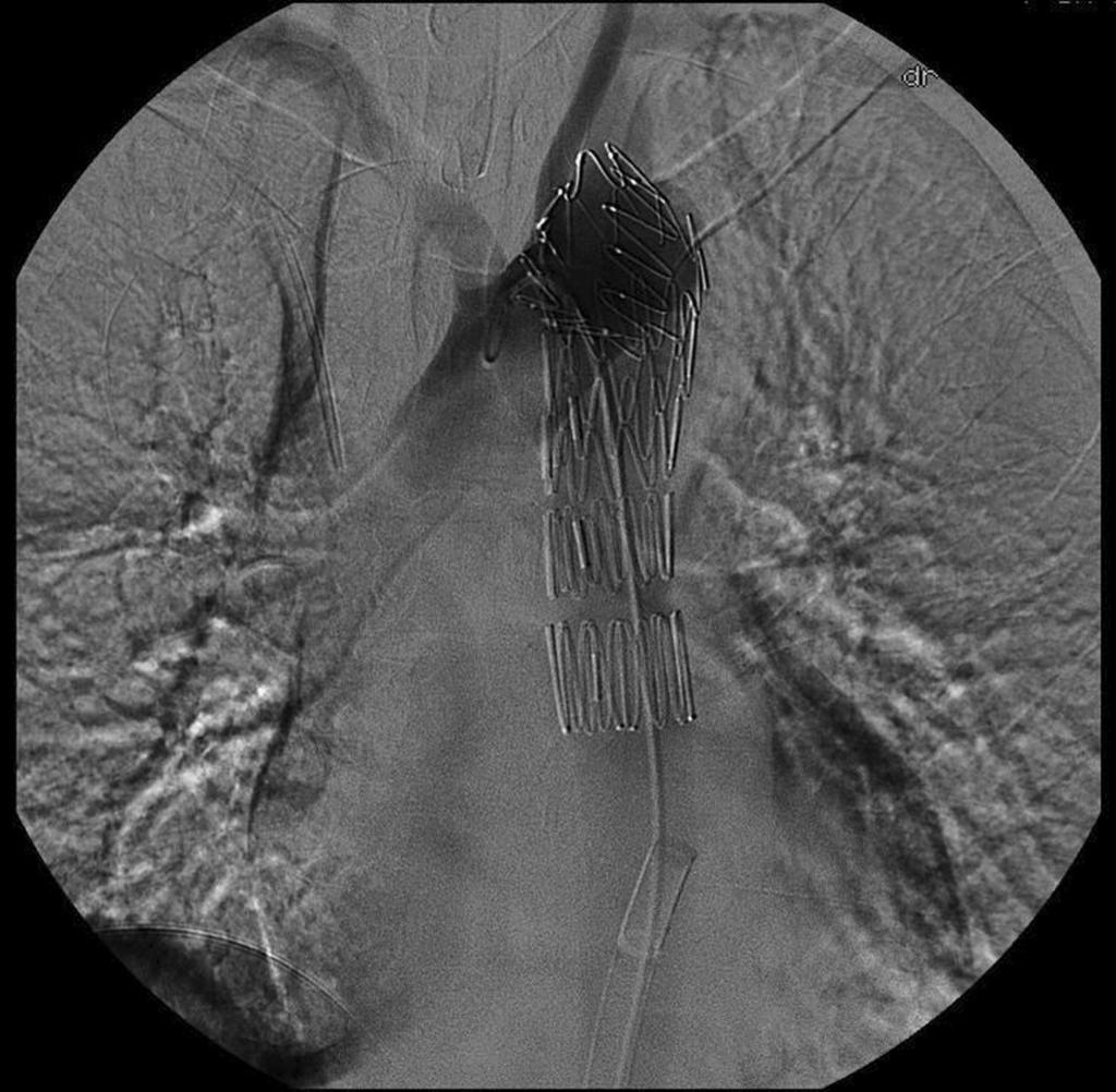 Acta Angiol, 2012, Vol. 18, No. 1 of the stent-graft had to begin just below the orifice of the common carotid artery.