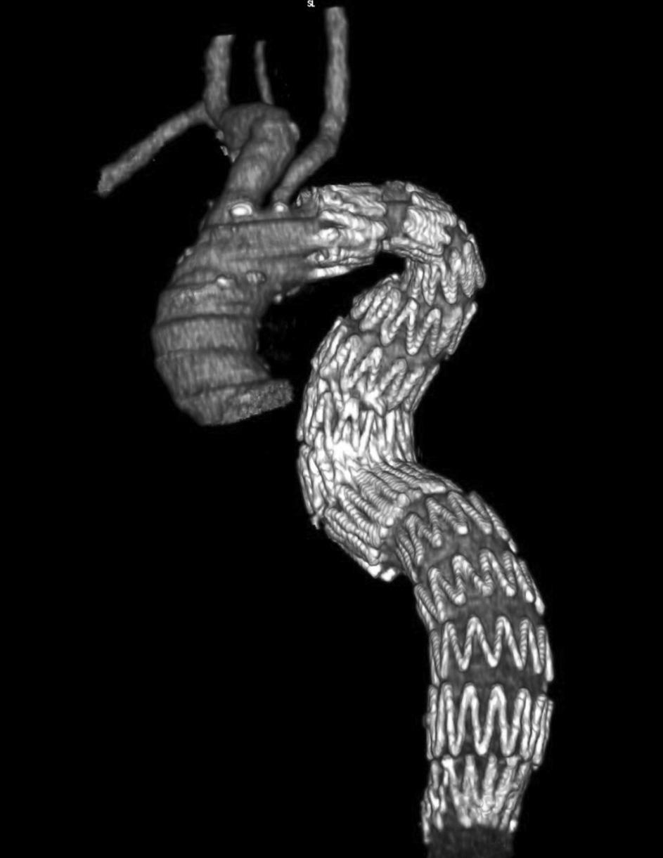 Radiation overdose in treatment of type B dissection, Stanišić et al. wykluczono po badaniu dermatologicznym, a wysypka została sklasyfikowana jako reakcja skórna na wysoką dawkę promieniowania.