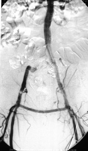 In 10 patients the bifurcated stent-grafts were used and the internal iliac artery was unilaterally covered with the stent-graft (Fig. 2).