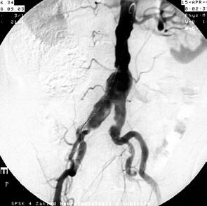 Acta Angiol., 2003, Vol. 9, No. 2 A B Figure 2. A. Aortography. Aneurysm of the abdominal aorta and iliac arteries, on the right down as far as the origin of internal iliac artery; B.