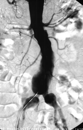 Clinical consequences of closure of internal iliac arteries in patients with AAA, Szczerbo-Trojanowska et al. A B C Figure 3. A. Aortography. Aneurysm of the abdominal aorta and iliac arteries; B.