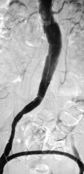 Control aortography the late arterial phase showing opacification of the branches of the internal iliac arteries Rycina 3. A. Aortografia.