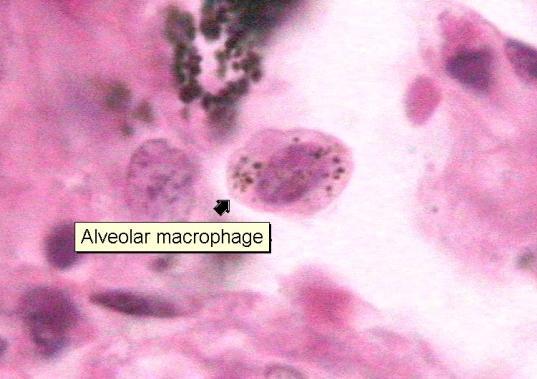 Makrofagi pęcherzykowe Makrofag pęcherzykowy Cienka ściana pęcherzyka nie jest przeszkodą dla bakterii.