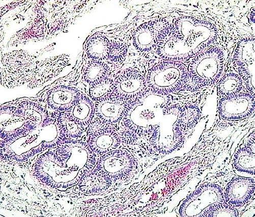 Prace kliniczne i kazuistyczne Ryc. 9. Macica klaczy proliferacja gruczołów z powstawaniem tzw. gniazd gruczołowych otoczonych torebką zbudowaną z włóknistego zrębu błony śluzowej.