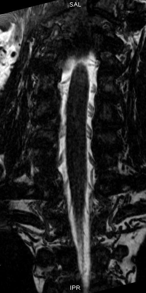 Anatomia MR kręgosłupa rdzeń kręgowy korzenie