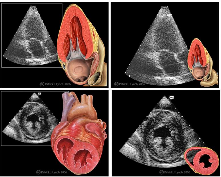 zasięgowej regulacji wzmocnienia, przed przetwornikiem analogowo-cyfrowym. Rys 4. Sposoby obrazowania serca spomiędzy żeber V i VI (u góry) i spod mostka (u dołu) [autor: Patrick J.