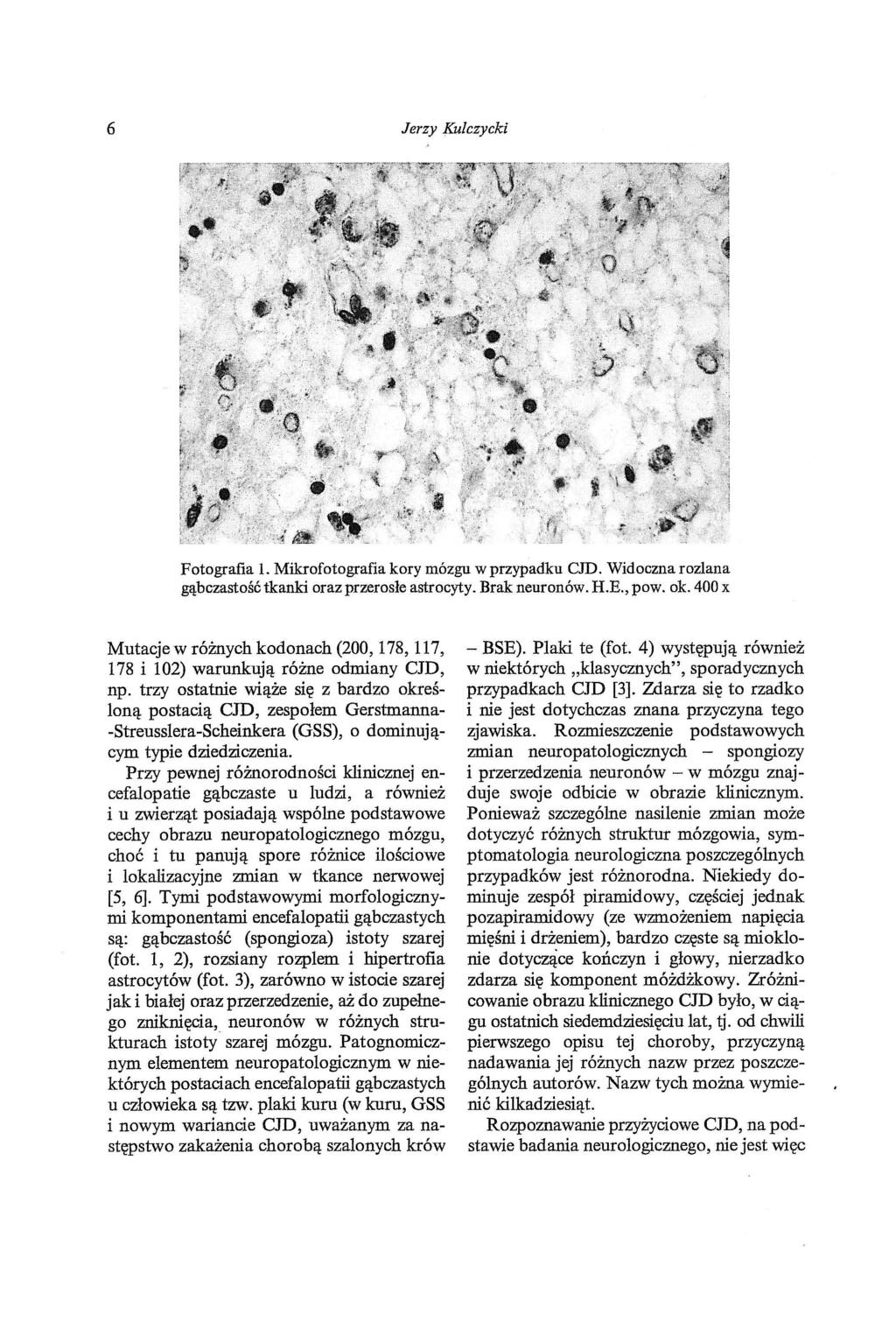 6 Jerzy Kulczycld Fotografia 1. Mikrofotografia kory mózgu w przypadku CJD. Widoczna rozlana gąbczastość tkanki oraz przerosłe astrocyty. Brak neuronów. H.E., pow. ok.