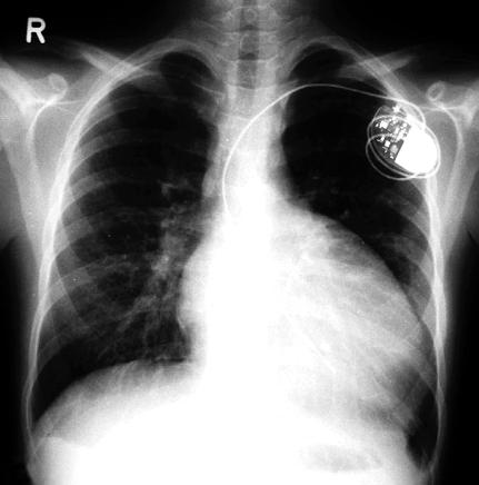 420 Joanna Kwiatkowska et al implantacji uk³adu stymuluj¹cego serce.