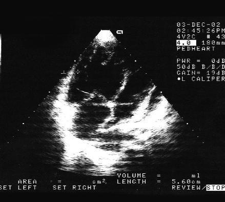 6 mies. póÿniej stan kliniczny dziewczynki uleg³ znacznemu pogorszeniu. Wyst¹pi³y objawy niewydolnoœci kr¹ enia.