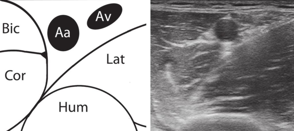 Anestezjologia Intensywna Terapia 2015; tom 47, nr 4, 423 430 Rycina 1. Schemat i obraz ultrasonograficzny proksymalnej ramienia Rycina 2.