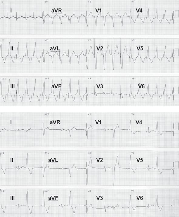 Folia Cardiologica Excerpta 2006, tom 1, nr 4 A B Rycina 3. Technika pace mapping dająca zgodność obrazów QRS wystymulowanych z obrazami QRS arytmii (pacjent nr 11). A. Wystymulowany obraz QRS z miejsca aplikacji energii o wysokiej częstotliwości; B.