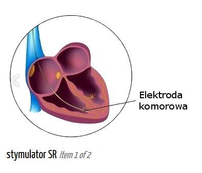 Tryby pracy stymulatora serca Tryb jedno-jamowy (AAI elektroda w przedsionku, VVI elektroda w komorze) Jedna elektroda (przedsionek lub komora) monitorowanie pracy serca Rytm