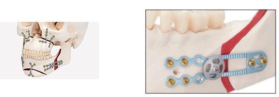 Miniplates are also used in the operative treatment of morphological defects of the mandible.