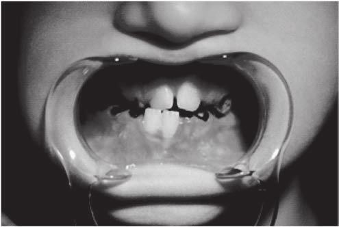 Malocclusions and craniofacial anomalies in a child with velo-cardio-facial syndrome 493 Fig. 2. The mandible deviates to the right by the width of 1 mandibular incisor. Ryc. 2. Zbaczanie żuchwy w prawą stronę o szerokość około 1 zęba siecznego dolnego.